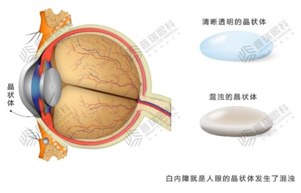 金瑞鼎盛 看东西模糊、视力下降？合肥普瑞眼科：小心“潜伏”在眼内的致盲杀手——白内障_大皖新闻 | 安徽网